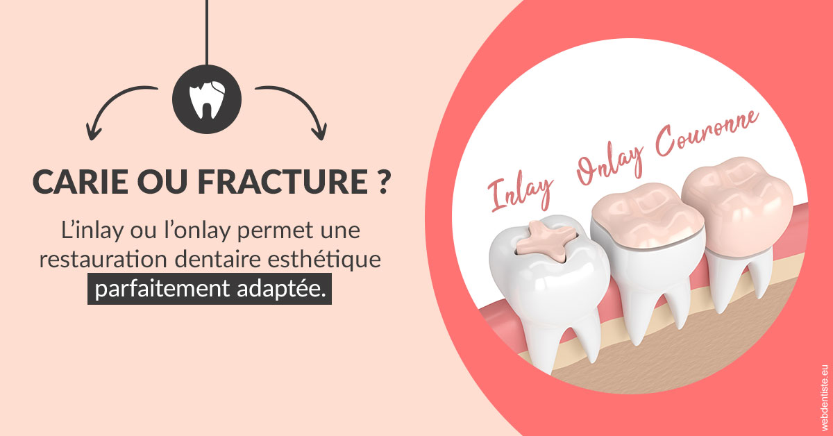 https://dr-aoun-naji.chirurgiens-dentistes.fr/T2 2023 - Carie ou fracture 2