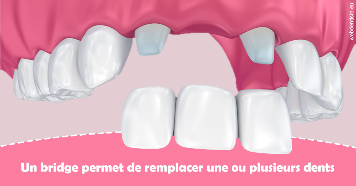 https://dr-aoun-naji.chirurgiens-dentistes.fr/Bridge remplacer dents 2