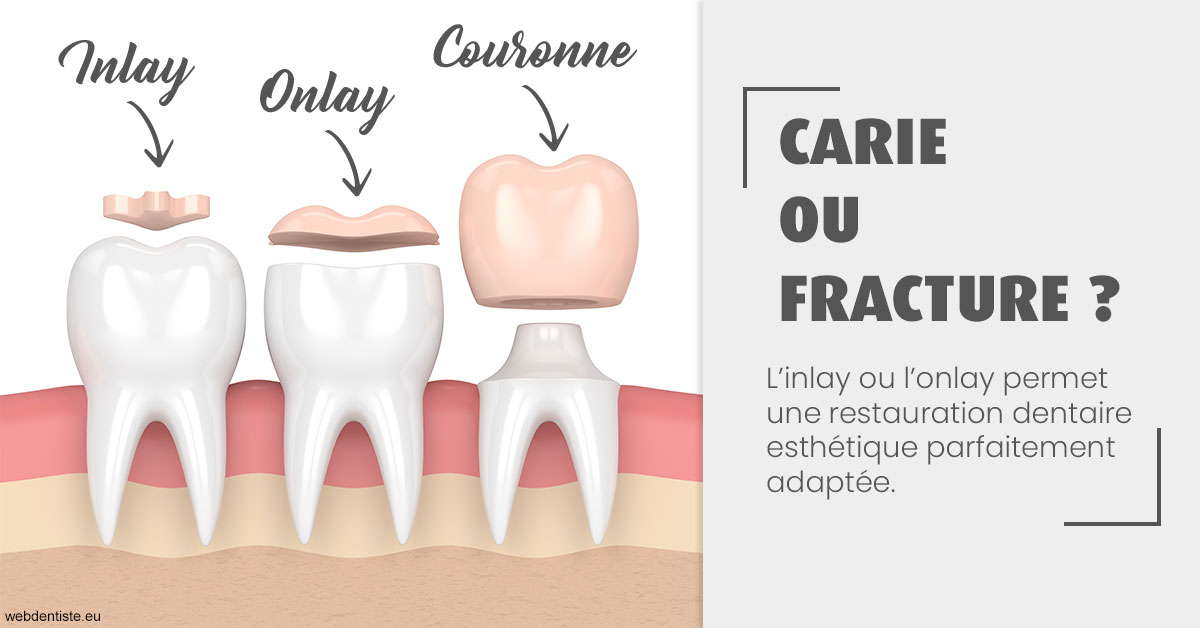 https://dr-aoun-naji.chirurgiens-dentistes.fr/T2 2023 - Carie ou fracture 1